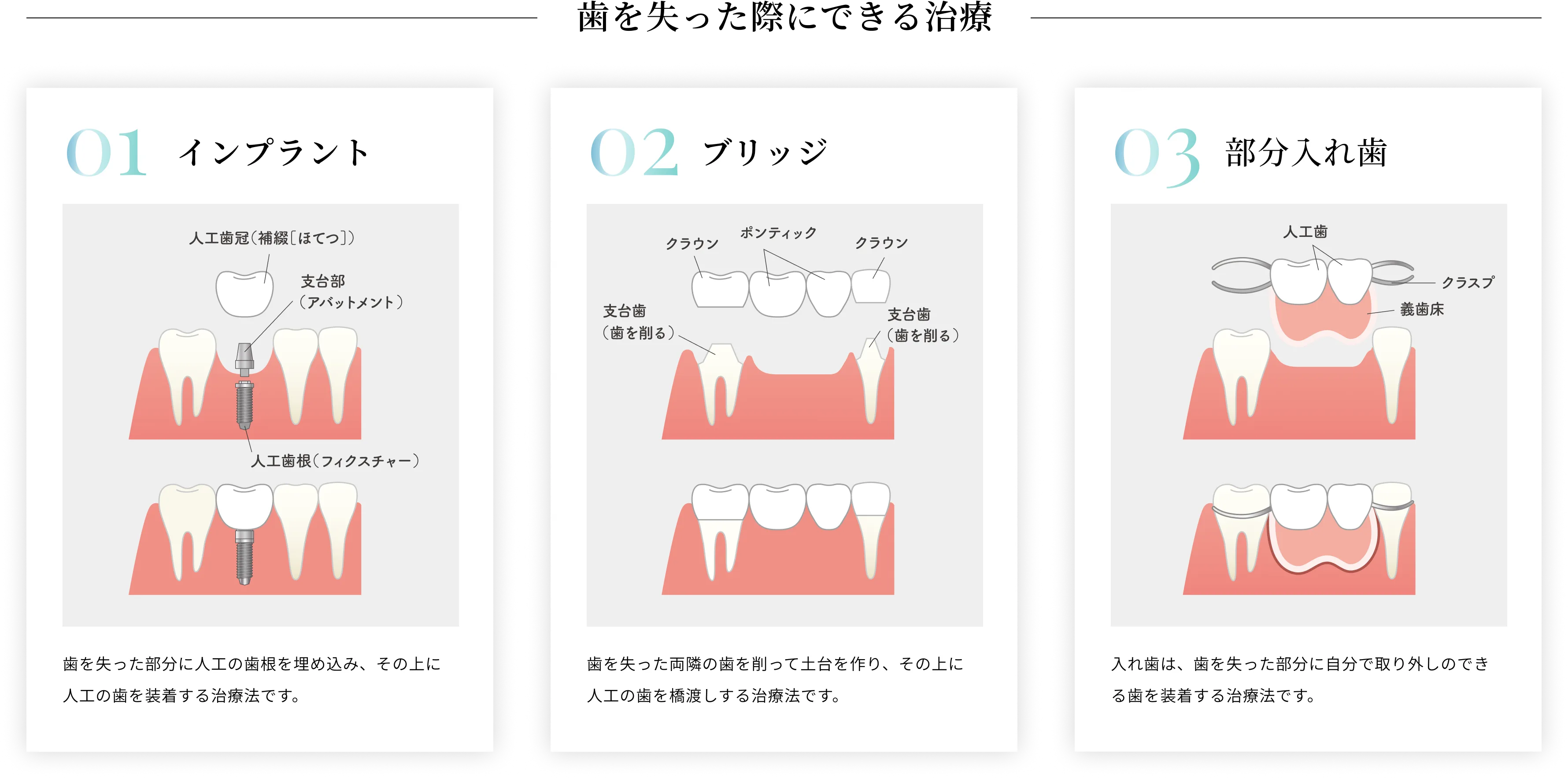 歯を失った際にできる治療